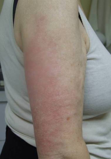 After — Cellulite reduction