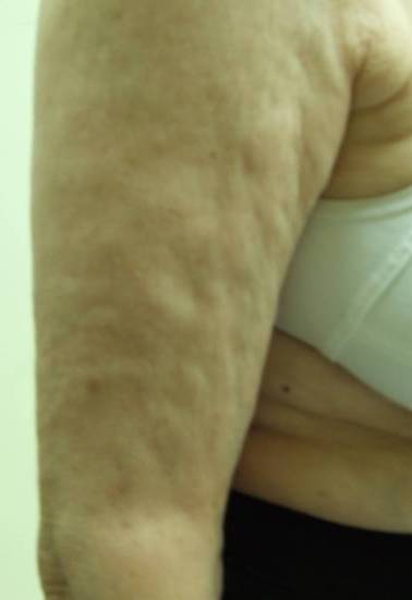 Before — Cellulite reduction