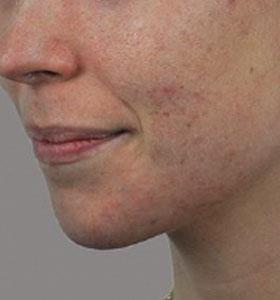 Before — Traitement de l’acné