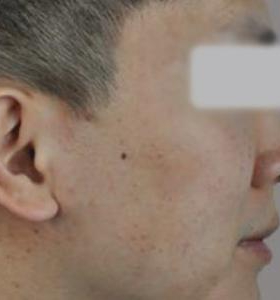 After — Acne treatment