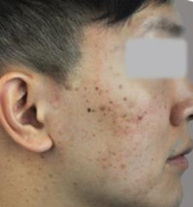 Before — Acne treatment