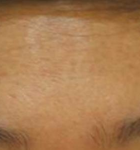 After — Acne treatment