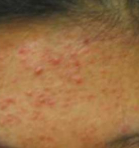 Before — Acne treatment