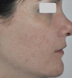 After — Acne treatment