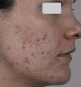 Before — Acne treatment
