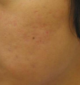 After — Acne treatment