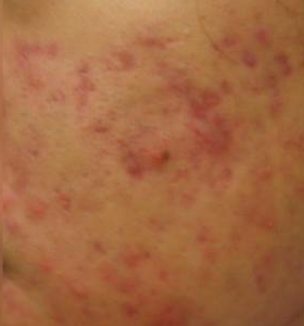 Before — Acne treatment