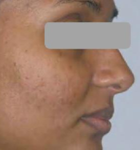 After — Facial au carbone