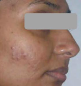 Before — Facial au carbone