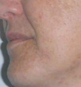 After — Carbon facial
