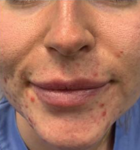 Before — Carbon facial