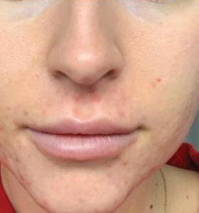 After — Carbon facial