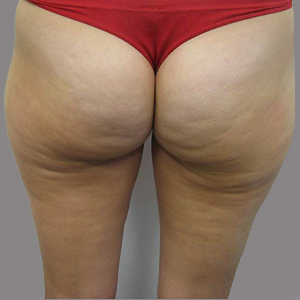After — Réduction de la cellulite