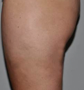 After — Cellulite reduction