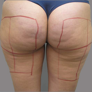 Before — Réduction de la cellulite
