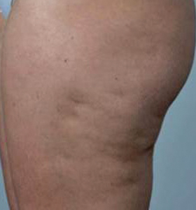 Before — Cellulite reduction