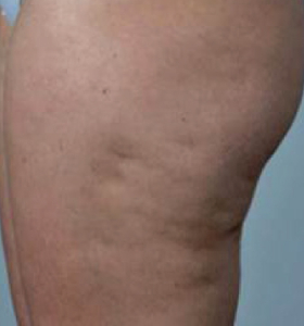 Before — Raffermissement corporel