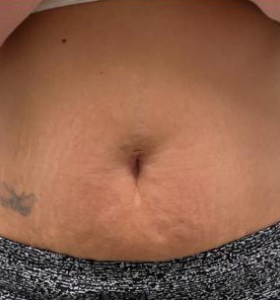 After — Body tightening