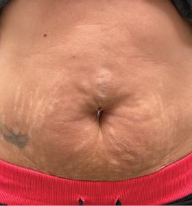 Before — Body tightening