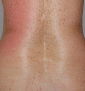 After — Body tightening