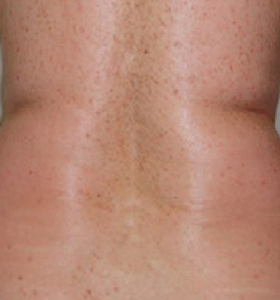 Before — Body tightening