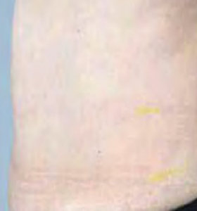 After — Body tightening