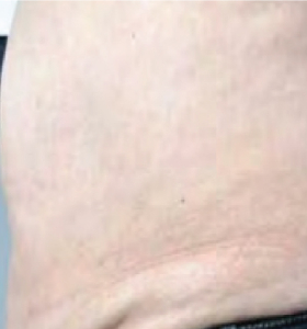 Before — Body tightening