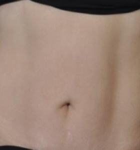 After — Body contouring