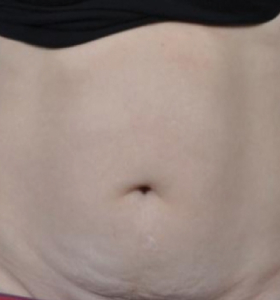 Before — Body contouring