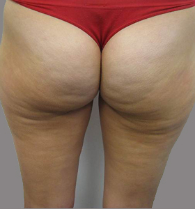 After — Body contouring