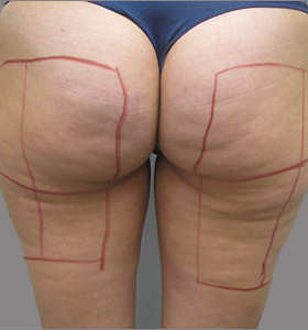 Before — Body contouring