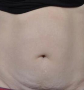 Before — Body contouring