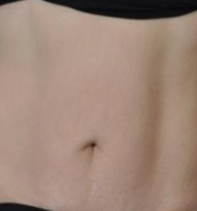 After — Body contouring
