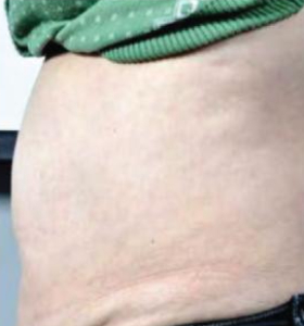 Before — Body contouring