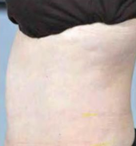 After — Body contouring