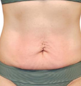 After — Contour corporel