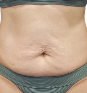 Before — Contour corporel