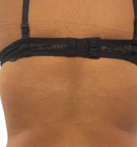 After — Body tightening