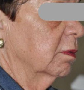 Before — Contour du visage