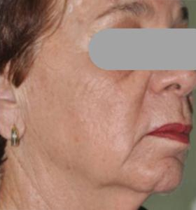 After — Contour du visage