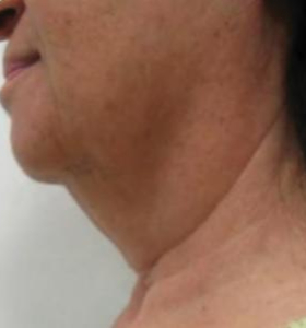 After — Facial contouring