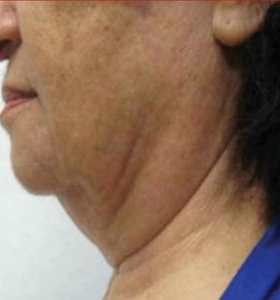 Before — Facial contouring
