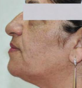After — Facial contouring