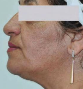 Before — Facial contouring