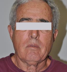 After — Facial contouring