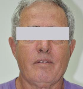 Before — Facial contouring