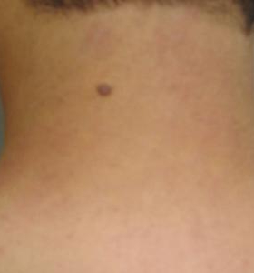 After — Hair removal
