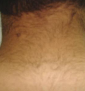 Before — Hair removal