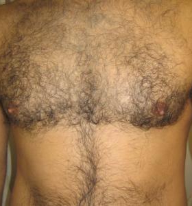 Before — Hair removal