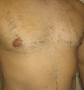 After — Hair removal